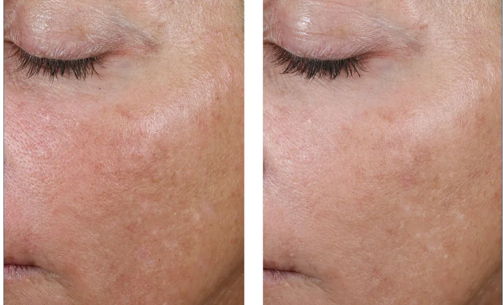 Cheek tone and pigmentation, before and after eight weeks