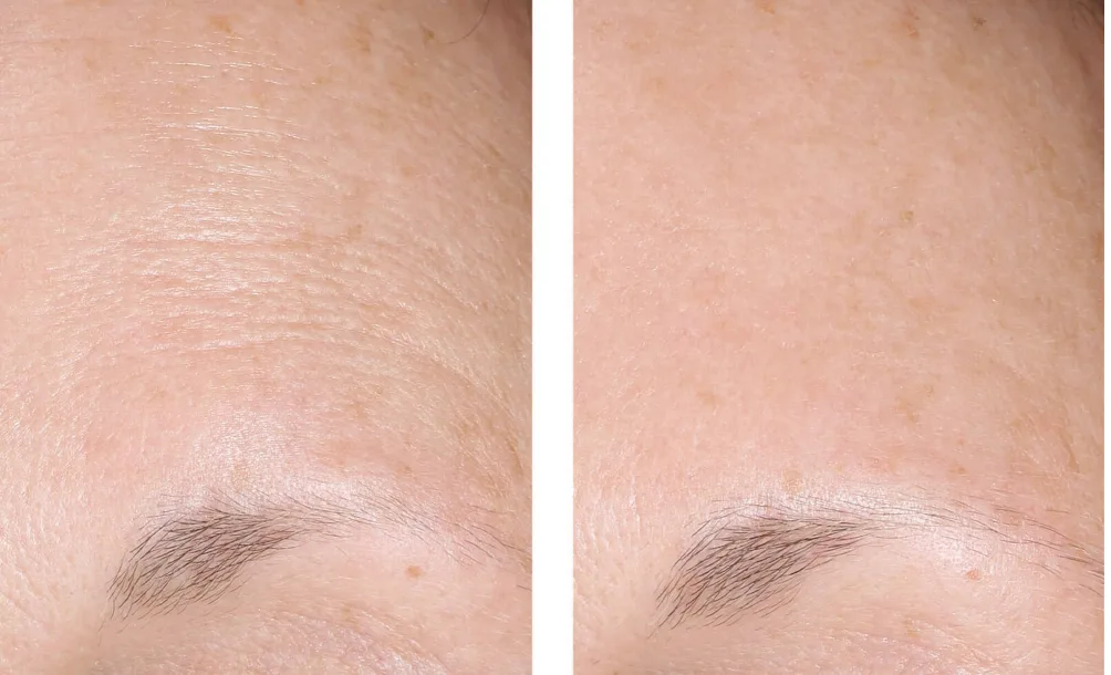 Forehead skin texture, before and after four weeks